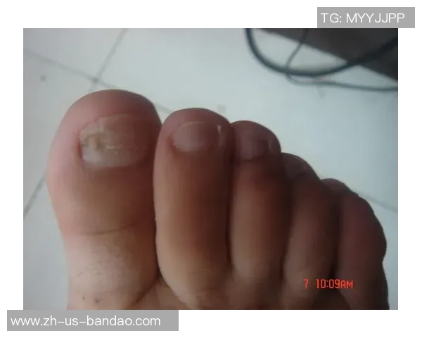 足球灰指甲的成因与预防措施解析助你远离脚部健康隐患